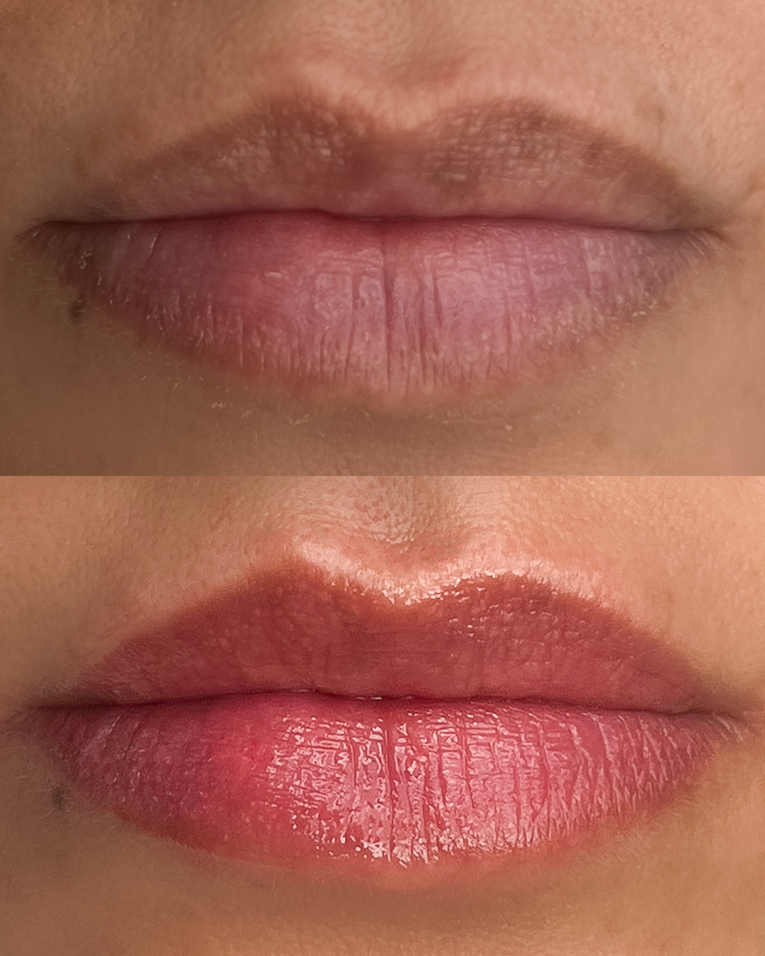 Neutralização labial antes e depois